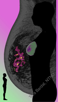 mammografi